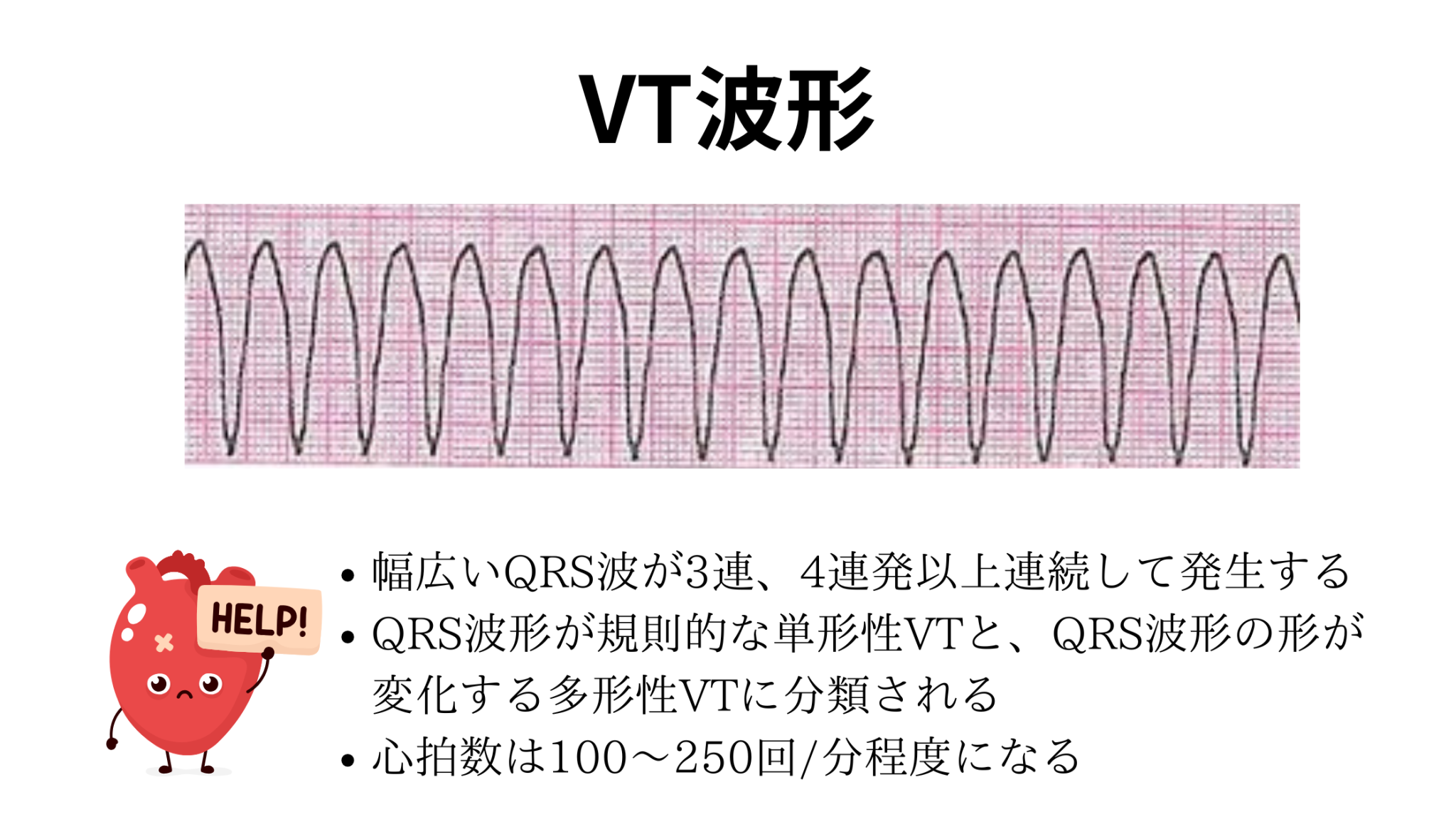 【看護師必見】VT(心室頻拍)の心電図判読と緊急対応|見逃さない4ステップガイド - しごとレトリバーガイド