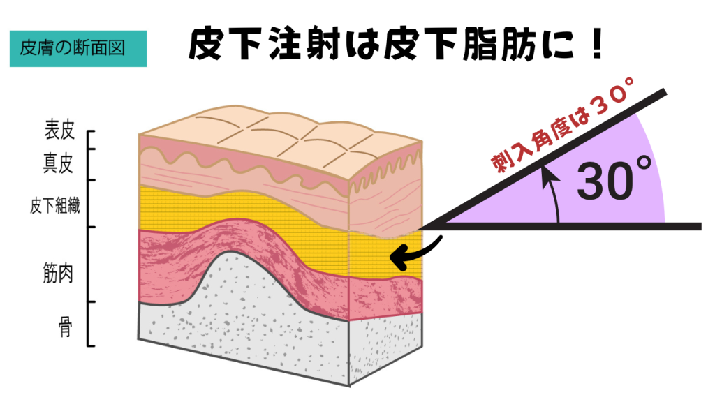 🩺皮下注射の基本手技を完全マスター! - しごとレトリバーガイド