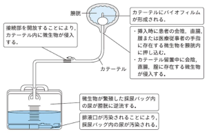 【看護師必見】膀胱留置カテーテル管理の5つのポイン …