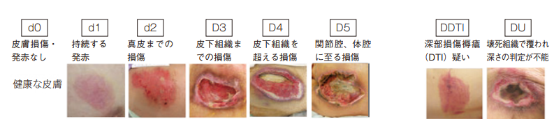 Design R Tool 褥瘡 壊死細胞 処置 – 褥瘡 壊死組織 除去 , 褥瘡治療の基礎知識 – DAUV