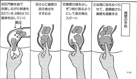 摘便の方法