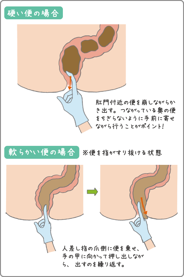 「摘便」をうまくやるコツ