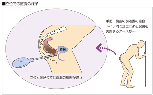 トイレ内浣腸