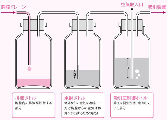 ドレナージ（水封）のしくみとドレナージ中の患者の観察点
