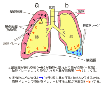 胸腔ドレーンの挿入部位図解