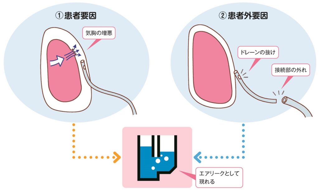 エアリークの図解
