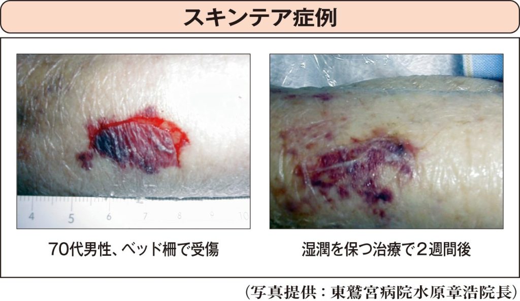 スキンテアの症例