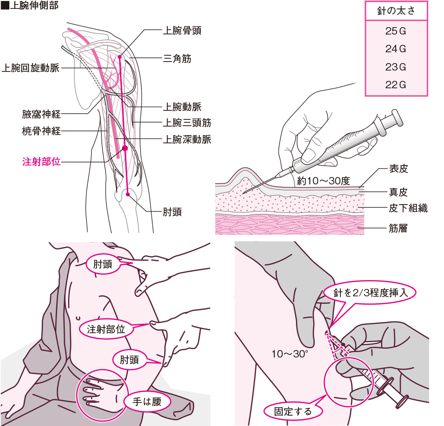 皮下注射の部位の解説イラスト