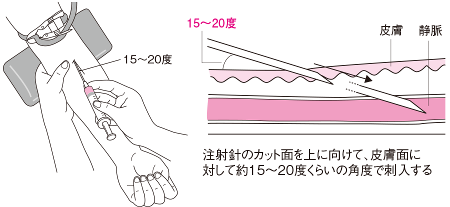 採血時の針の刺入角度