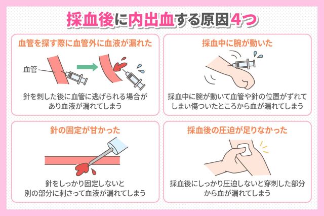 採血後の内出血を防ぐコツ