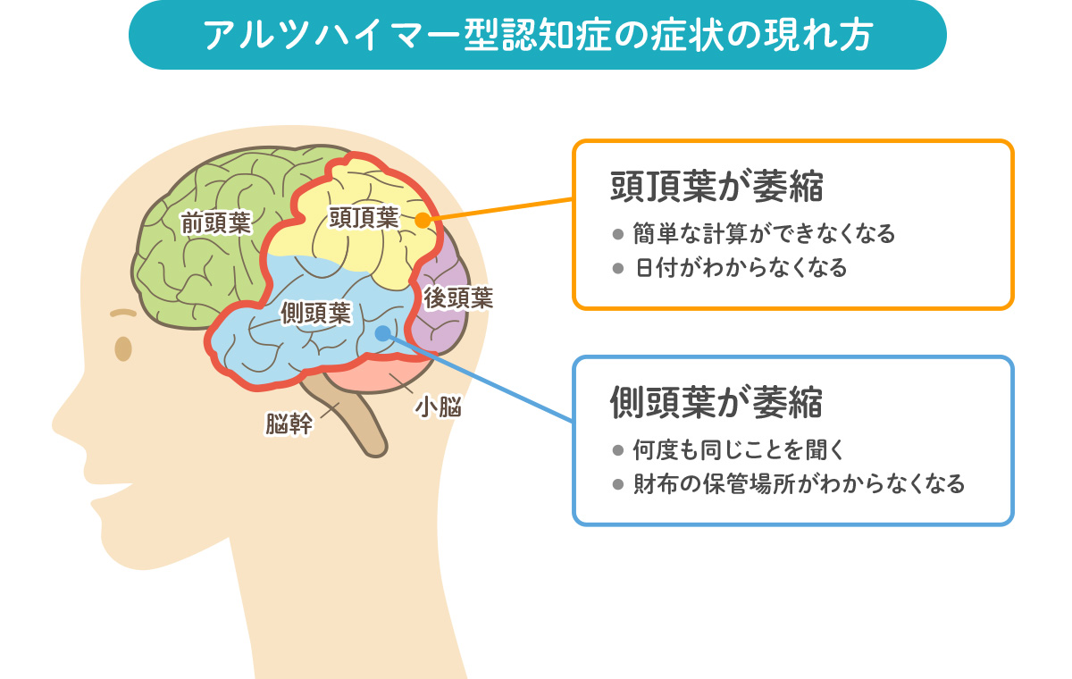アルツハイマー型認知症