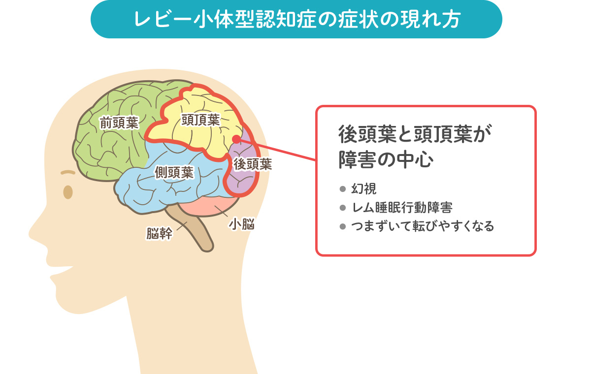 レビー小体型認知症