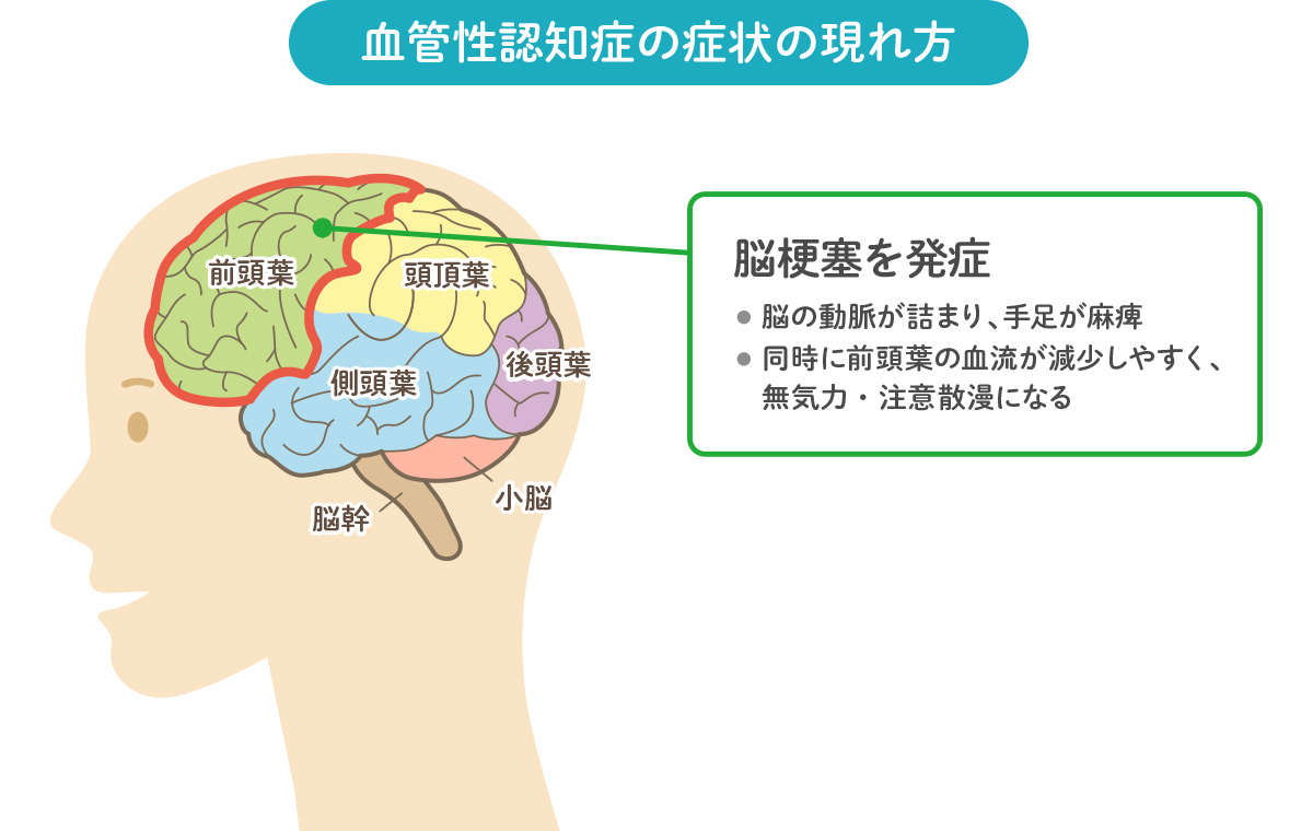 血管性認知症