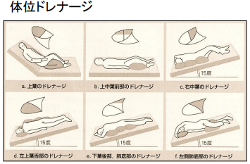 体位ドレナージ 