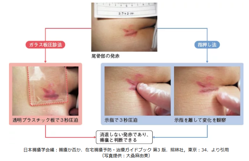 非退色性紅斑