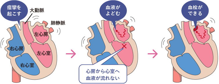心房細動　血栓