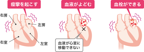 心房細動