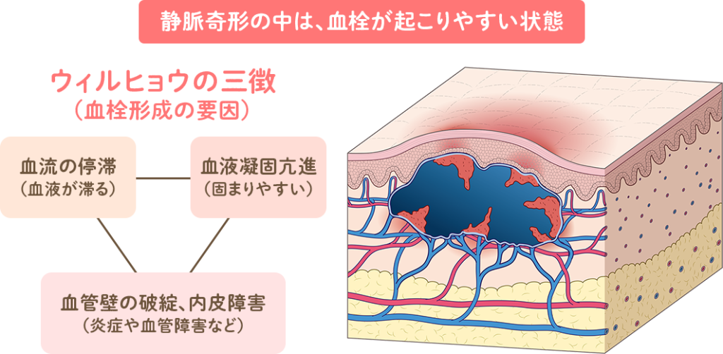 ウィルヒョウの3徴