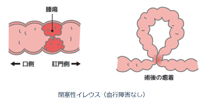 イレウス