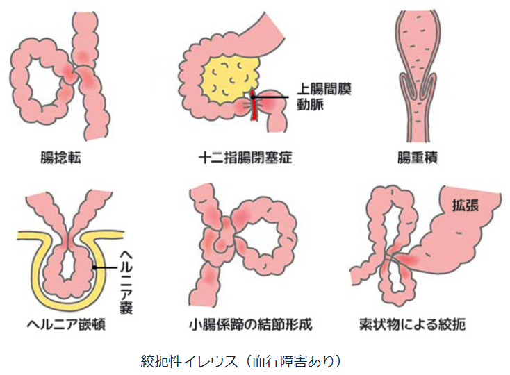 絞扼性イレウス（血行障害あり）