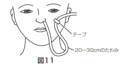 イレウスチューブの固定