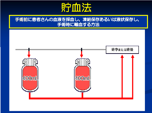 貯血法 