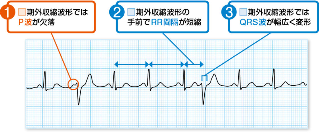 PVC　心電図