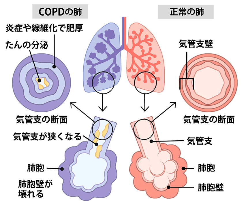 COPD