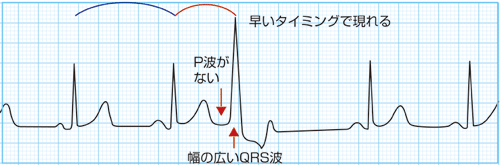 PVC　心電図