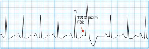 RonT型