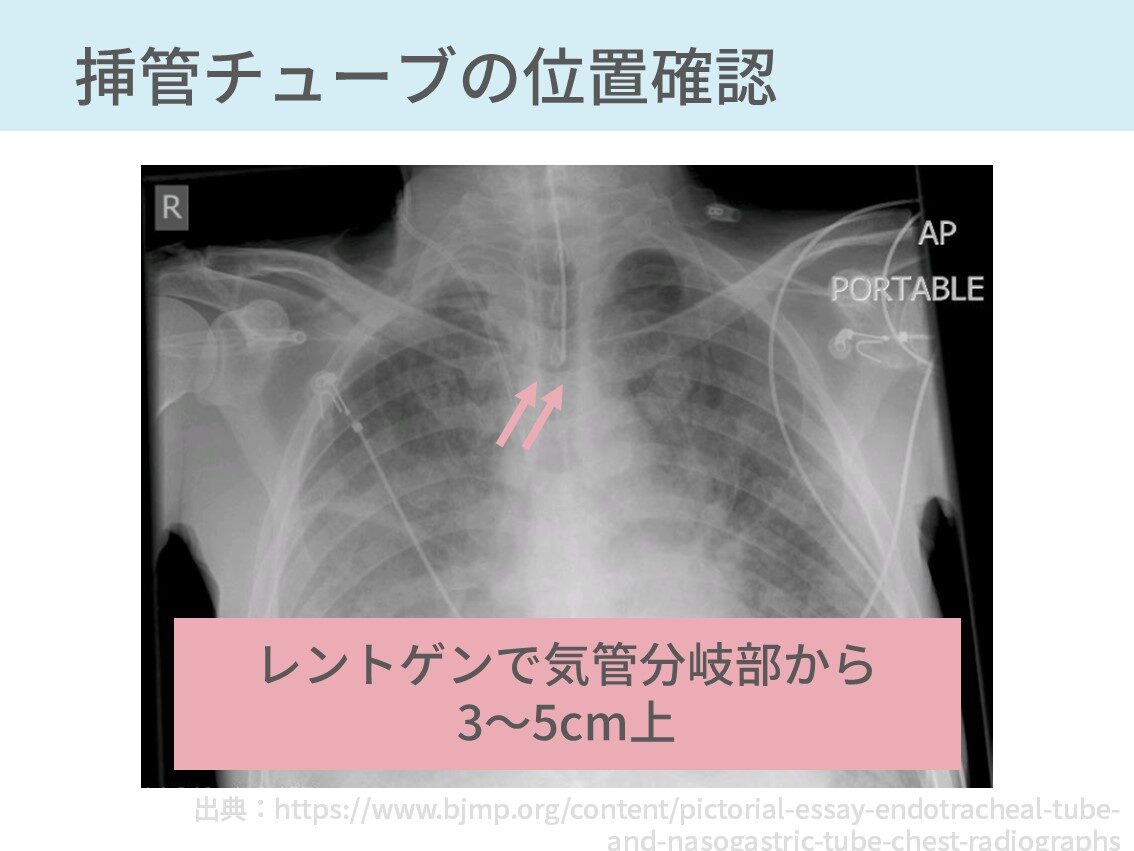 気道緊急 その2】 DAMのうち 事前に準備することができる場合では （予定の全身麻酔手術など） 「挿管困難予測」を行う🧐 ポイントは  語呂合わせ：LEMONS🍋 (危険因子、3-3-2の法則、Mallampati分類) と Cormack分類👅, image size:1134x851
