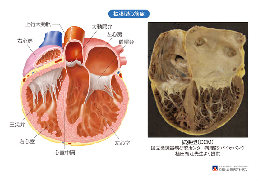 拡張型心筋調