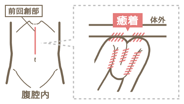 術後　腸閉塞　癒着
