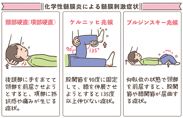 髄膜刺激症状
