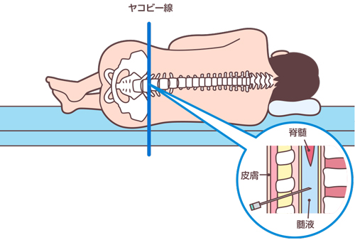腰椎穿刺　看護