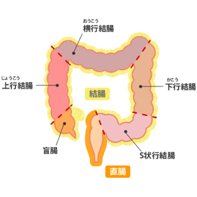 大腸がん　結腸癌　直腸がん