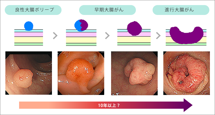 大腸ポリープ　癌化