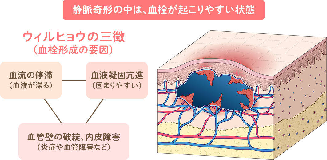 Virchowの三徴