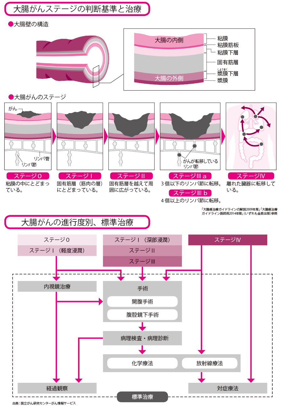 大腸がん　治療