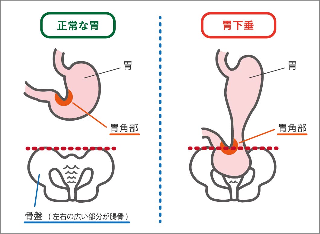 胃下垂