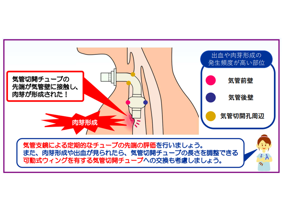 気管切開　吸引　チューブ　挿入　長さ　目安