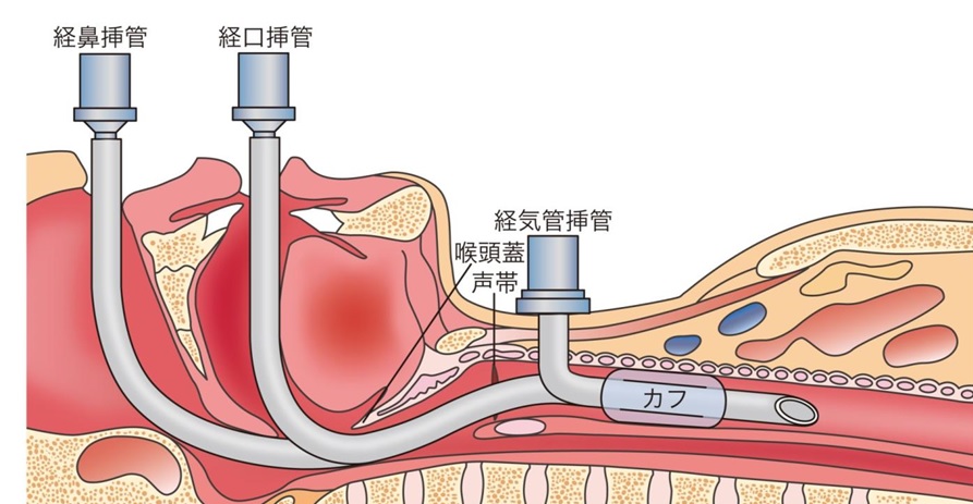 気管切開の図