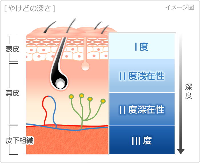 やけど 熱傷 ピンプリックテスト