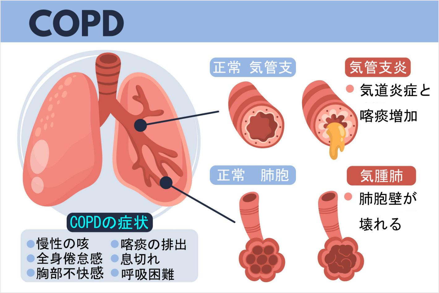 COPD
