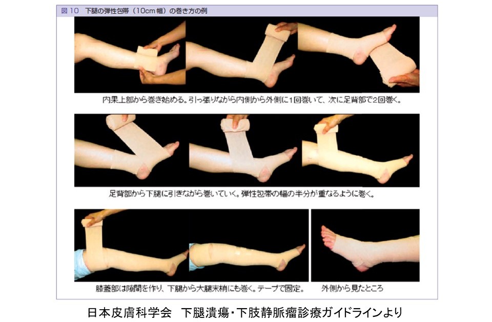 弾性ストッキング　浮腫　褥瘡