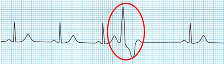 心室期外収縮時の心電図
