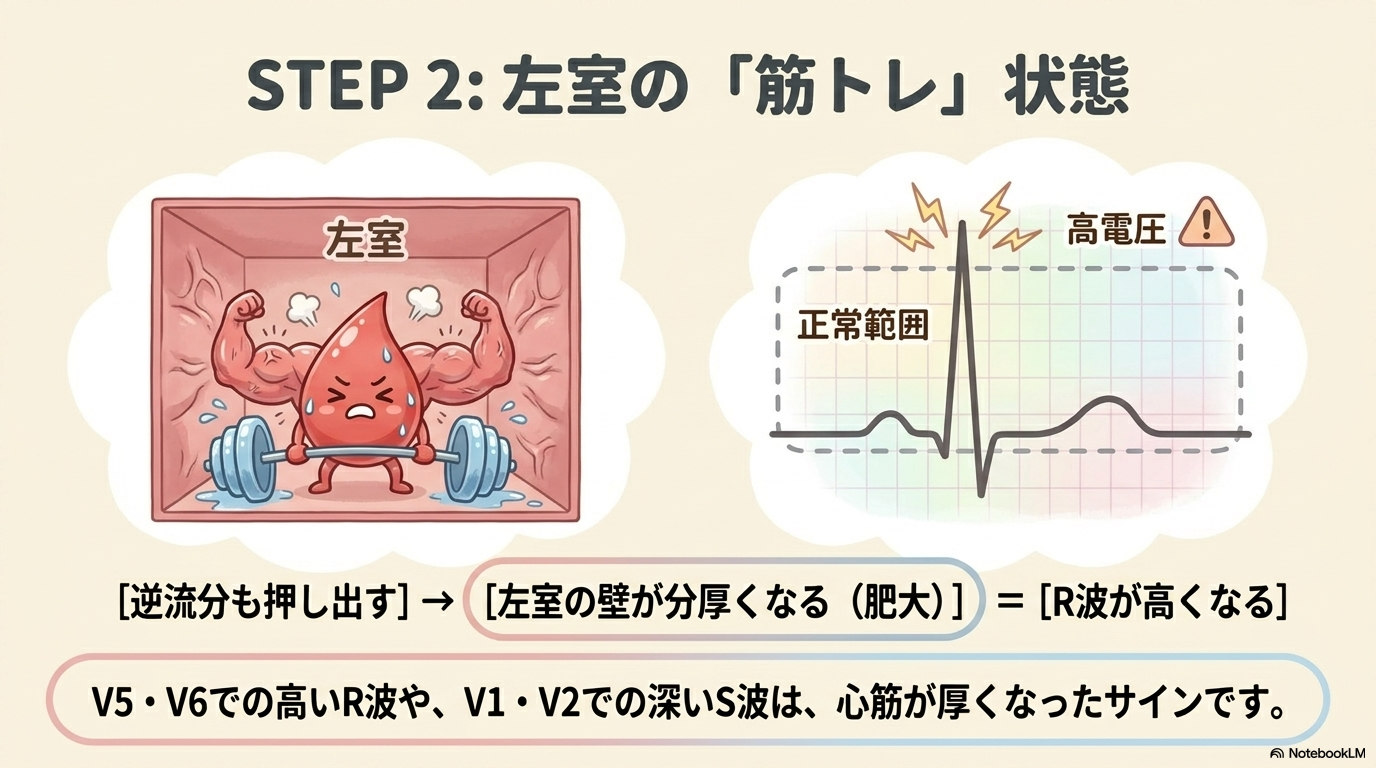 僧帽弁閉鎖不全症の心電図変化