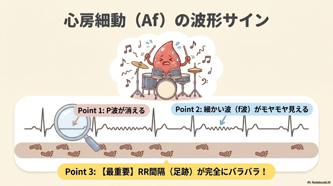 僧帽弁閉鎖不全症の心電図変化