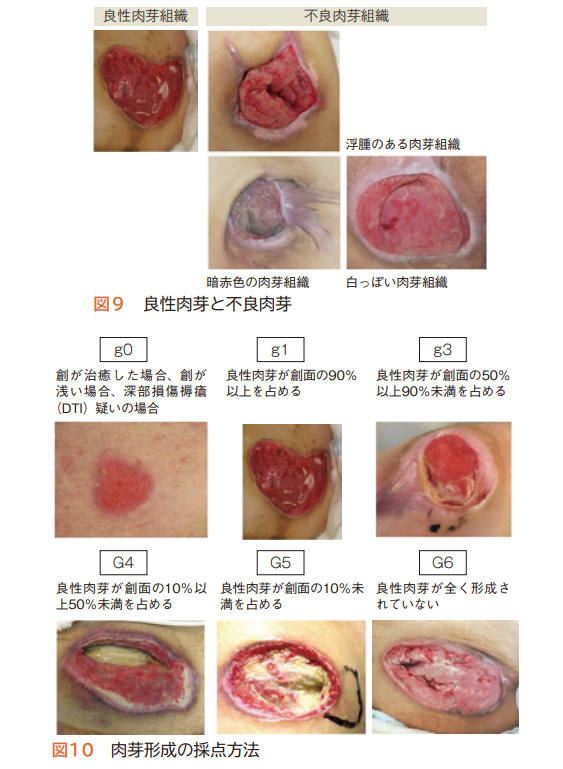 DESIGN-R褥瘡評価