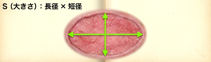 DESIGN-R
褥瘡評価